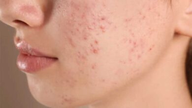मानसून में मुंहासों की समस्या से हैं परेशान, यह रहा हल