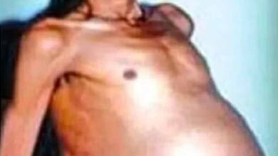 36 साल तक पेट में छिपे रहे जुड़वा भ्रूण, डॉक्टर भी रह गए हैरान