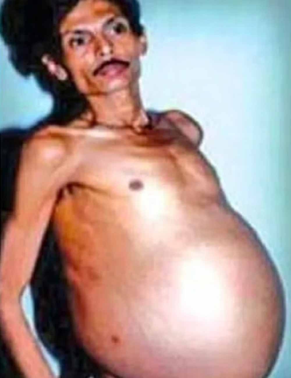 36 साल तक पेट में छिपे रहे जुड़वा भ्रूण, डॉक्टर भी रह गए हैरान