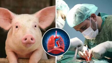 ब्रेन डेड मरीज पर पहली बार सूअर का फेफड़ा लगाया गया, साइंस ने कर दिखाया करिश्मा ब्रेन डेड मरीज पर पहली बार सूअर का फेफड़ा लगाया गया, साइंस ने कर दिखाया करिश्मा