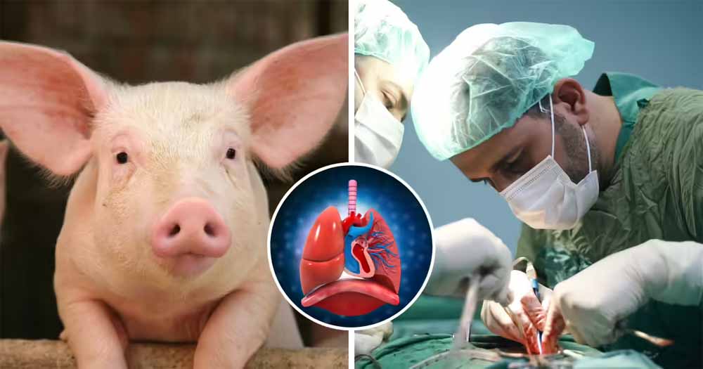 ब्रेन डेड मरीज पर पहली बार सूअर का फेफड़ा लगाया गया, साइंस ने कर दिखाया करिश्मा