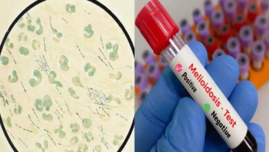 मध्यप्रदेश में मेलियोइडोसिस का अलर्ट, 4 राज्यों तक पहुंचा संक्रमण; मिट्टी-पानी से फैलता है जानलेवा रोग