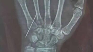 गोरखपुर में डॉक्टर की लापरवाही: 15 साल की बच्ची की नस में तोड़ा नीडल, CMO ने जांच के आदेश दिए