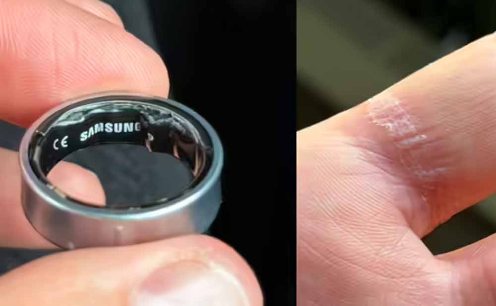 स्‍मार्ट रिंग बनी मुसीबत: एयरपोर्ट पर रोका गया यात्री, पहुंचा अस्‍पताल