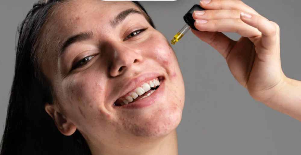 सैलिसिलिक एसिड का कमाल! पिंपल्स और दाग-धब्बों से मिलेगा झटपट छुटकारा