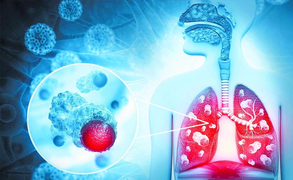 हर 9 में से 1 भारतीय को कैंसर का खतरा, पुरुषों में फेफड़े और महिलाओं में ब्रेस्ट कैंसर सबसे ज्यादा