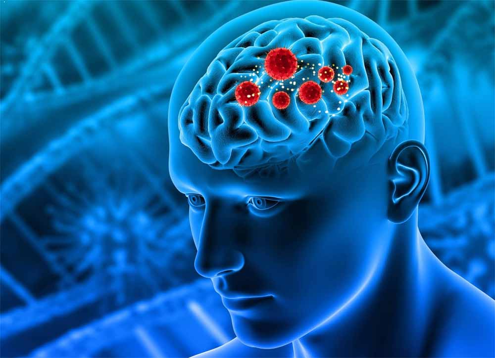 ब्रेन ट्यूमर के शुरुआती संकेत: अपने शरीर के ये अलर्ट कभी न करें नजरअंदाज