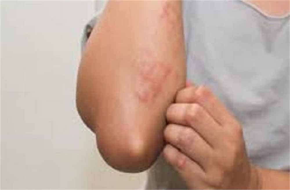 Kidney Alert: ड्राई और खुजली वाली त्वचा दे रही है खतरे का संकेत, डॉक्टर बोले– तुरंत कराएं जांच