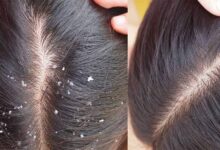 डैंड्रफ नहीं, स्कैल्प की गंभीर समस्या भी हो सकती है! तेल लगाने से पहले जान लें ये सच्चाई