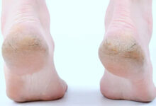 फटी एड़ियों की छुट्टी! 6 घरेलू नुस्खों से पाएं मक्खन जैसी मुलायम एड़ियां