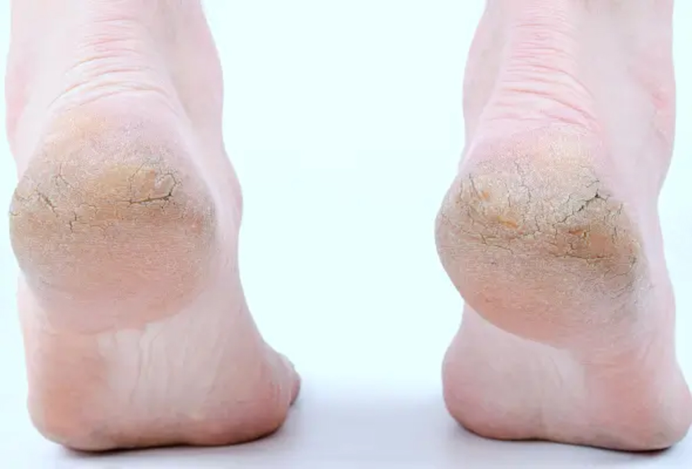 फटी एड़ियों की छुट्टी! 6 घरेलू नुस्खों से पाएं मक्खन जैसी मुलायम एड़ियां फटी एड़ियों की छुट्टी! 6 घरेलू नुस्खों से पाएं मक्खन जैसी मुलायम एड़ियां