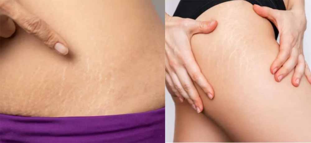 घर बैठे ऐसे मिटाएँ जिद्दी स्ट्रेच मार्क्स, बिना महंगे इलाज के