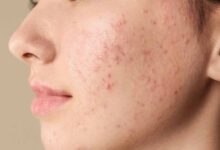 बार-बार पिंपल्स निकल रहे हैं? ये सिर्फ गंदगी नहीं, अंदर छिपी इन बीमारियों का हो सकता है संकेत