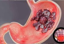 अल्सर से कैसा डर! जानिए इलाज और बचाव के आसान तरीके