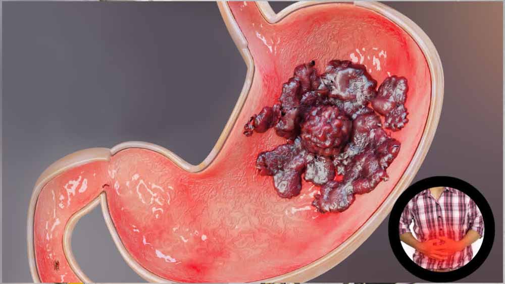 अल्सर से कैसा डर! जानिए इलाज और बचाव के आसान तरीके