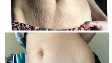 घर बैठे जिद्दी स्ट्रेच मार्क्स हटाने के आसान और असरदार तरीके