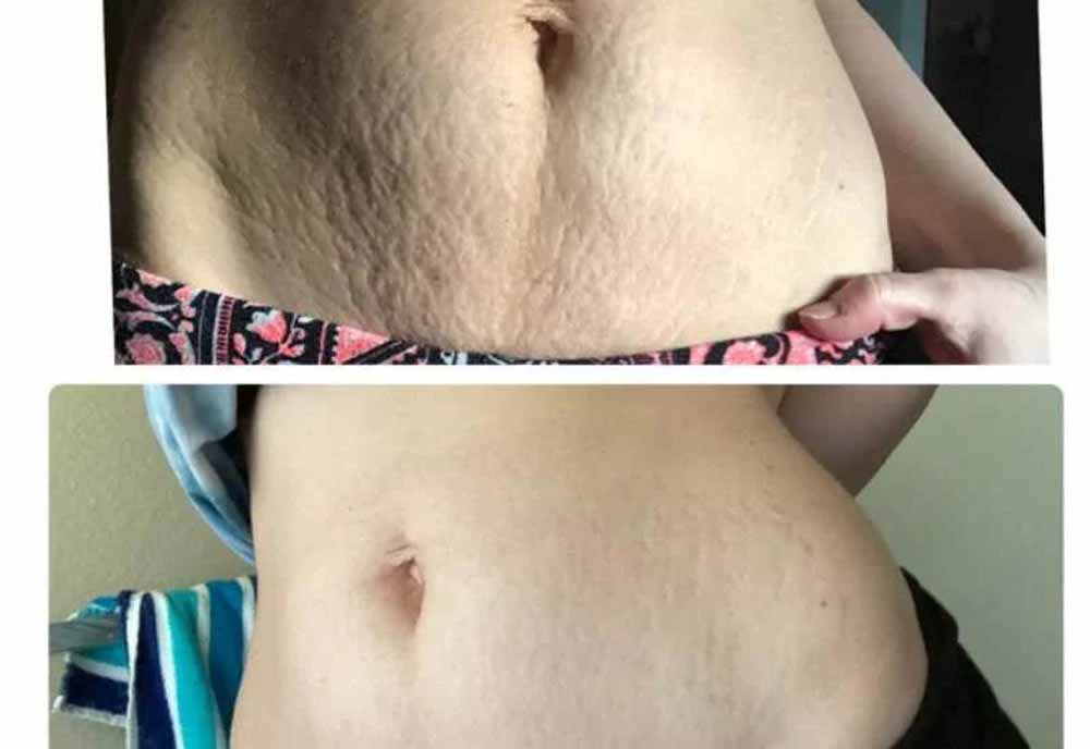 घर बैठे जिद्दी स्ट्रेच मार्क्स हटाने के आसान और असरदार तरीके घर बैठे जिद्दी स्ट्रेच मार्क्स हटाने के आसान और असरदार तरीके