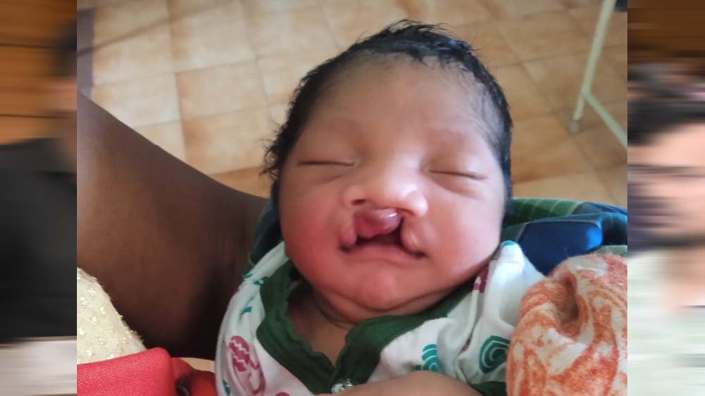 जब चिरायु टीम बनी एक परिवार की उम्मीद, जन्मजात विकृति से जूझ रहे बच्चे को मिला नया जीवन