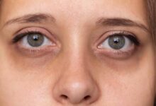 आंखों के काले घेरे से छुटकारा पाने के आसान और असरदार उपाय