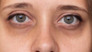 आंखों के काले घेरे से छुटकारा पाने के आसान और असरदार उपाय