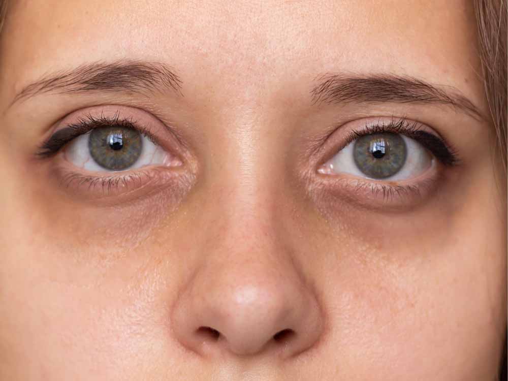 आंखों के काले घेरे से छुटकारा पाने के आसान और असरदार उपाय