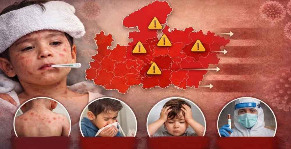 MP में खसरे की एंट्री: 4 जिलों में 12 नए मरीज, स्वास्थ्य विभाग अलर्ट मोड पर; घर-घर सर्वे शुरू