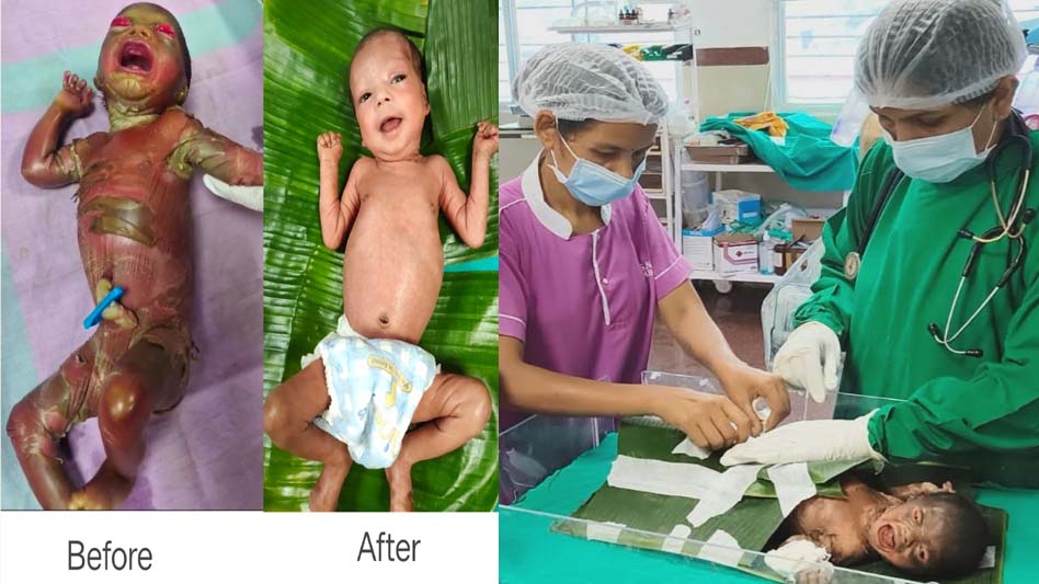 अत्यंत दुर्लभ बीमारी से जूझ रहे नवजात को बीजापुर जिला अस्पताल की SNCU में मिला नया जीवन