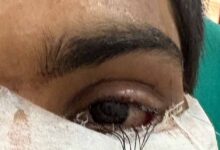स्किन ग्राफ्टिंग से मरीज के पलक का सफल पुनर्निर्माण