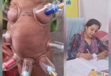लोहरसी आयुर्वेदिक औषधालय में दर्द प्रबंधन हेतु कपिंग थेरेपी एवं विशेष आयुर्वेदिक उपचार सेवाओं का आरंभ