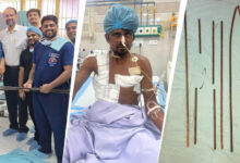 शरीर में आर-पार घुसे 4 लोहे के सरिये, KGMU के डॉक्टरों ने साढ़े आठ घंटे की सर्जरी से बचाई मजदूर की जान