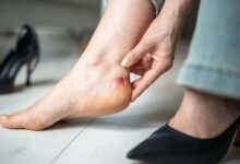 नए जूतों के छालों से राहत देंगे ये घरेलू नुस्खे, दर्द होगा दूर