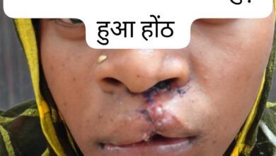 सफल सर्जरी से भीमे हेमला के चेहरे पर लौटी मुस्कान सफल सर्जरी से भीमे हेमला के चेहरे पर लौटी मुस्कान