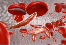 Sickle Cell Disease: देश के 59% मरीज ओडिशा और MP में मिले, 7.27 करोड़ लोगों की हुई जांच