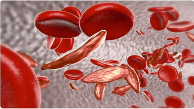 Sickle Cell Disease: देश के 59% मरीज ओडिशा और MP में मिले, 7.27 करोड़ लोगों की हुई जांच
