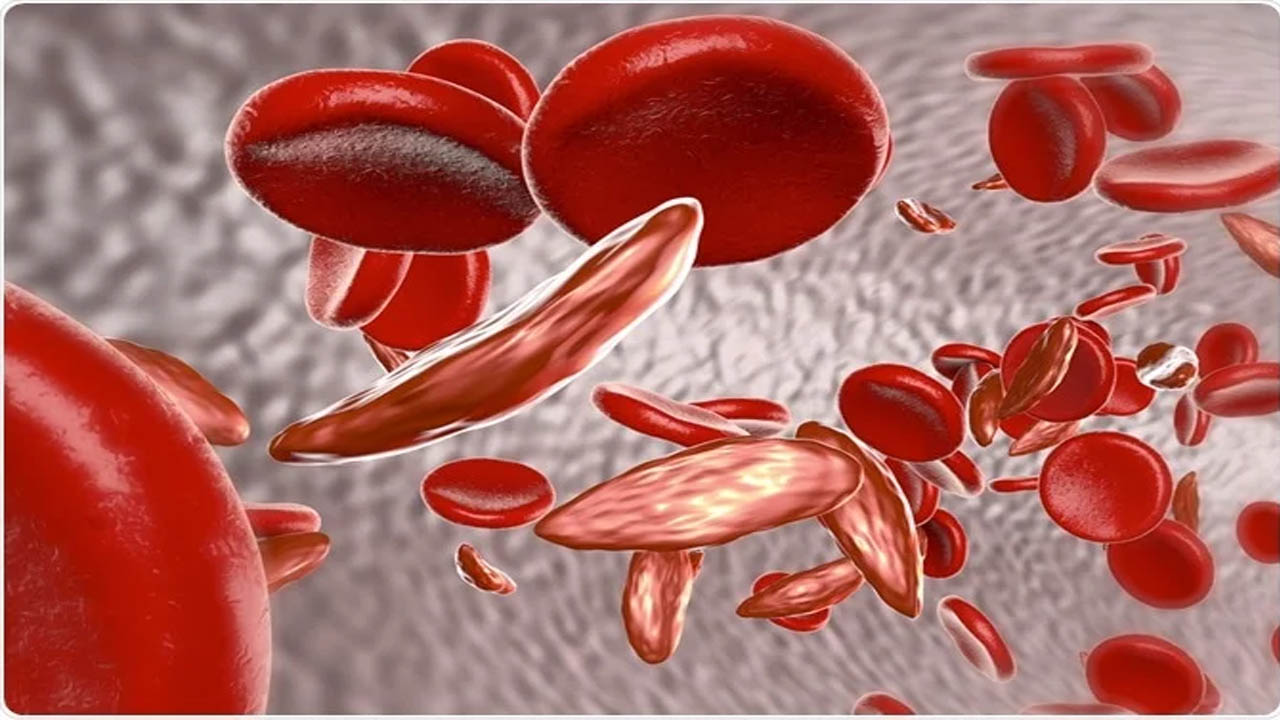 Sickle Cell Disease: देश के 59% मरीज ओडिशा और MP में मिले, 7.27 करोड़ लोगों की हुई जांच Sickle Cell Disease: देश के 59% मरीज ओडिशा और MP में मिले, 7.27 करोड़ लोगों की हुई जांच