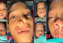 चिरायु योजना से जन्मजात समस्या से मिली राहत, तीन बच्चों के चेहरों पर लौटी मुस्कान